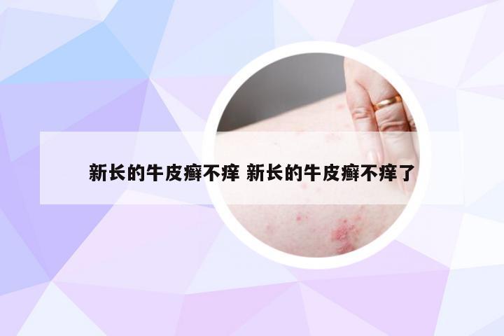 新长的牛皮癣不痒 新长的牛皮癣不痒了