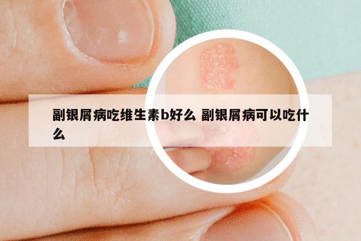 副银屑病吃维生素b好么 副银屑病可以吃什么