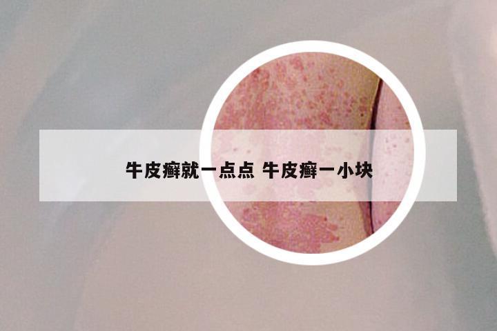 牛皮癣就一点点 牛皮癣一小块