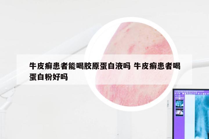 牛皮癣患者能喝胶原蛋白液吗 牛皮癣患者喝蛋白粉好吗