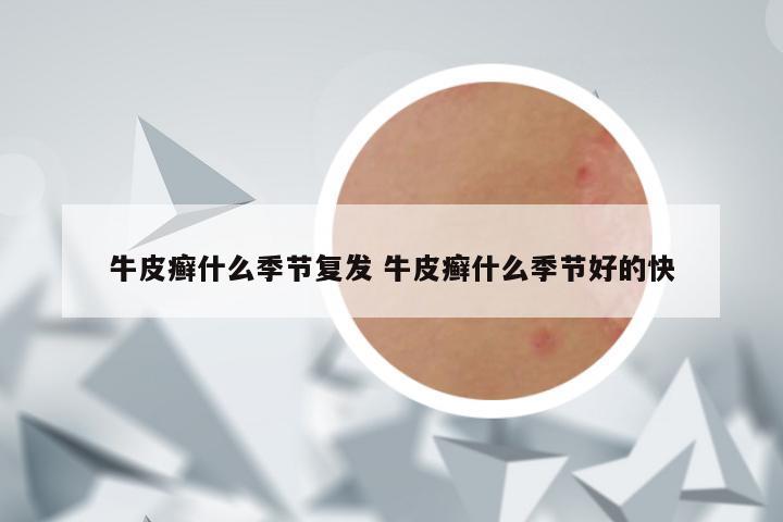 牛皮癣什么季节复发 牛皮癣什么季节好的快