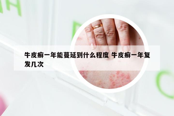 牛皮癣一年能蔓延到什么程度 牛皮癣一年复发几次
