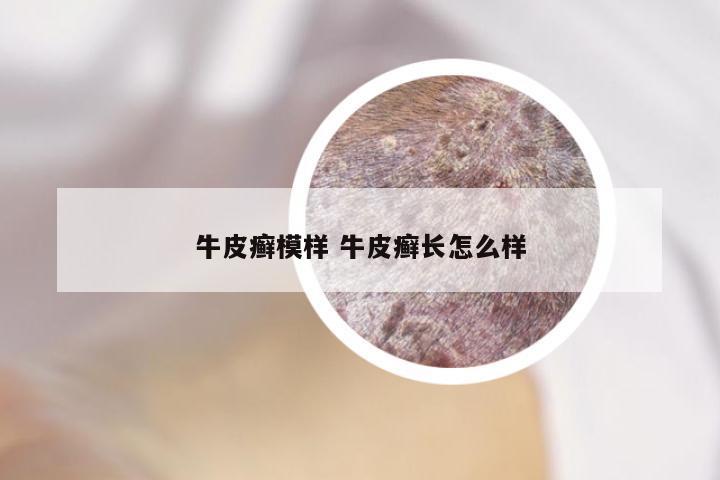 牛皮癣模样 牛皮癣长怎么样