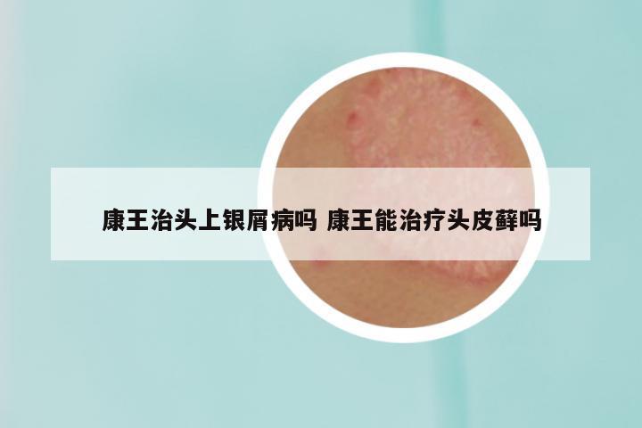 康王治头上银屑病吗 康王能治疗头皮藓吗