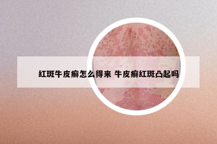 红斑牛皮癣怎么得来 牛皮癣红斑凸起吗