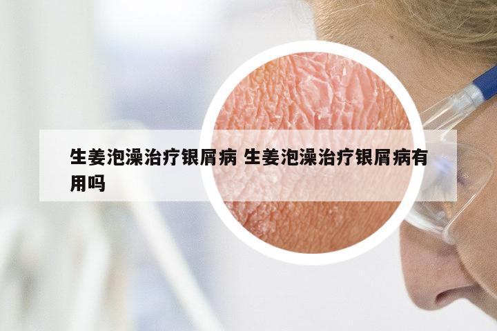 生姜泡澡治疗银屑病 生姜泡澡治疗银屑病有用吗