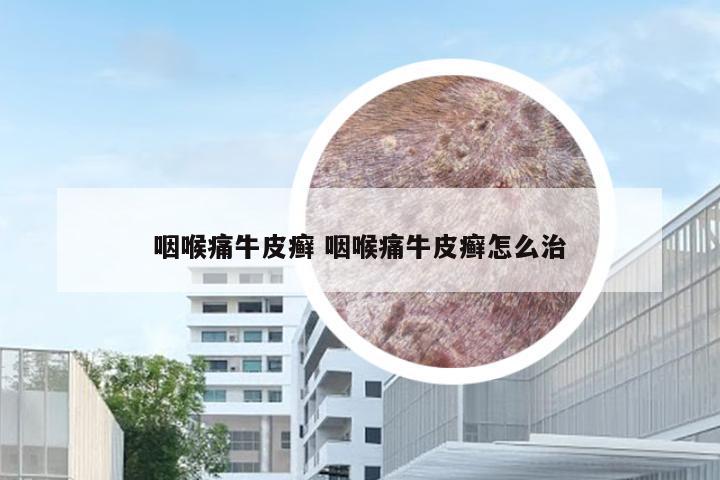 咽喉痛牛皮癣 咽喉痛牛皮癣怎么治