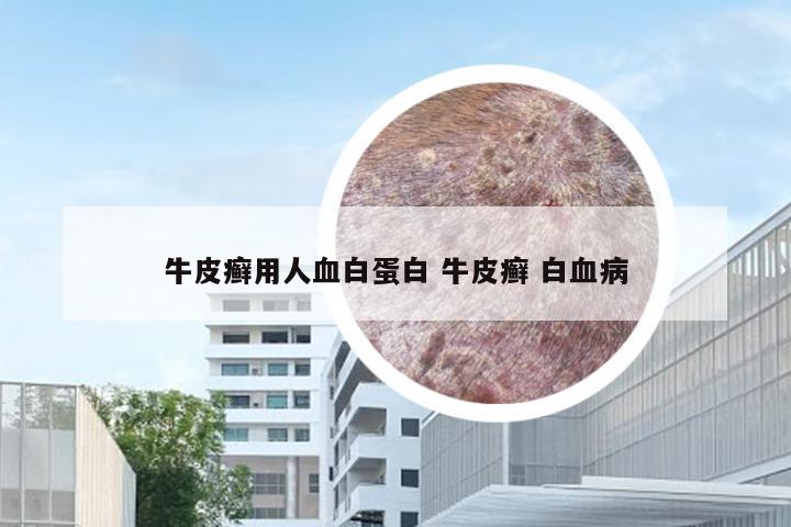 牛皮癣用人血白蛋白 牛皮癣 白血病