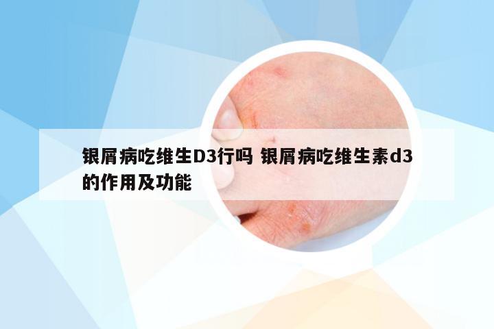 银屑病吃维生D3行吗 银屑病吃维生素d3的作用及功能