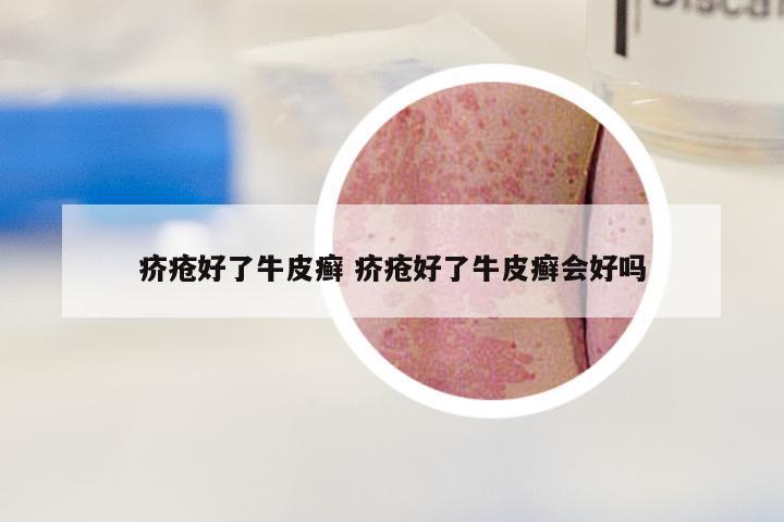 疥疮好了牛皮癣 疥疮好了牛皮癣会好吗