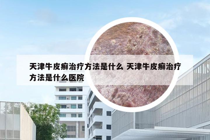 天津牛皮癣治疗方法是什么 天津牛皮癣治疗方法是什么医院