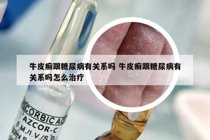牛皮癣跟糖尿病有关系吗 牛皮癣跟糖尿病有关系吗怎么治疗