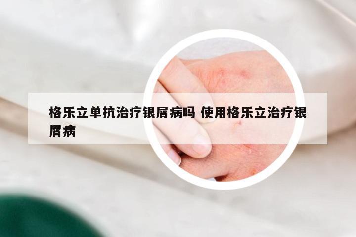 格乐立单抗治疗银屑病吗 使用格乐立治疗银屑病