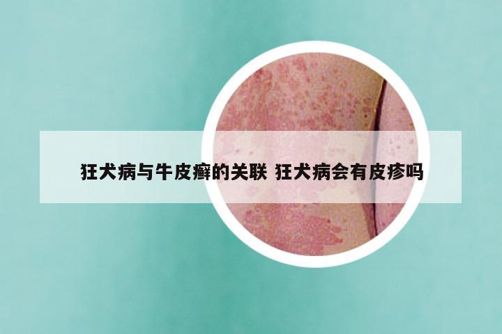 狂犬病与牛皮癣的关联 狂犬病会有皮疹吗