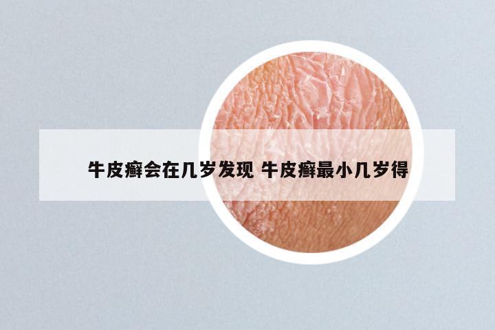 牛皮癣会在几岁发现 牛皮癣最小几岁得