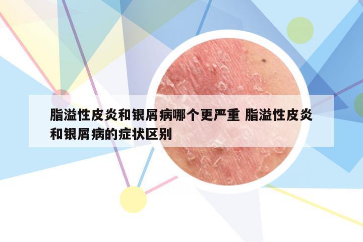 脂溢性皮炎和银屑病哪个更严重 脂溢性皮炎和银屑病的症状区别