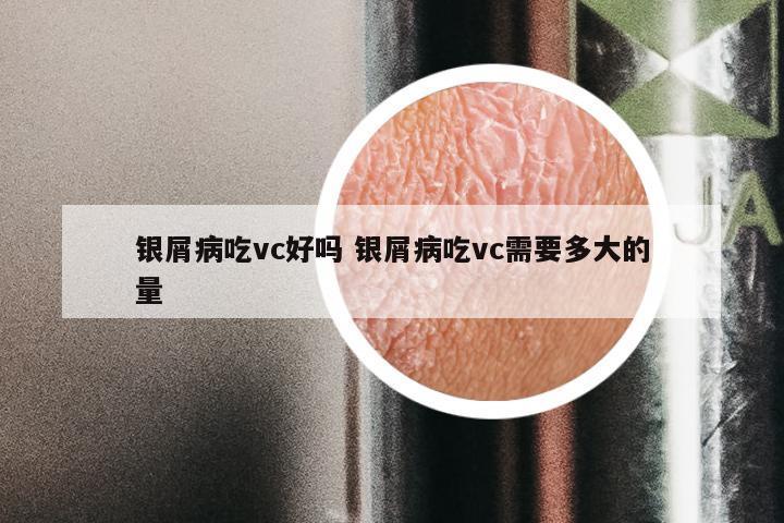 银屑病吃vc好吗 银屑病吃vc需要多大的量