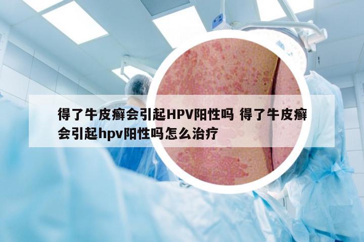 得了牛皮癣会引起HPV阳性吗 得了牛皮癣会引起hpv阳性吗怎么治疗