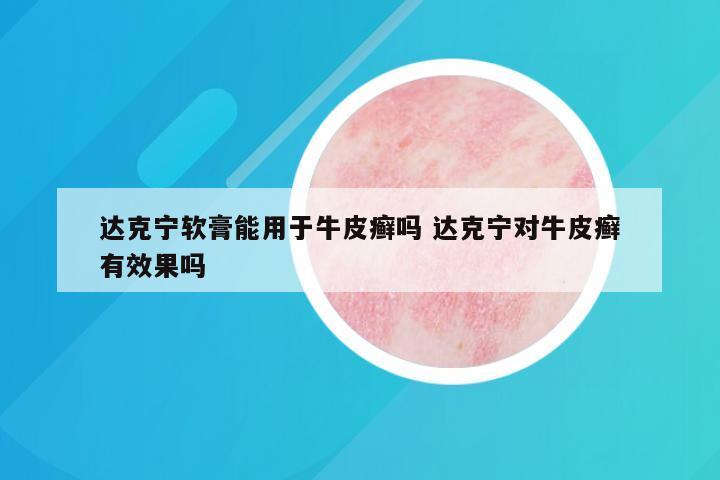 达克宁软膏能用于牛皮癣吗 达克宁对牛皮癣有效果吗