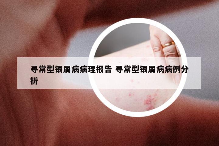寻常型银屑病病理报告 寻常型银屑病病例分析