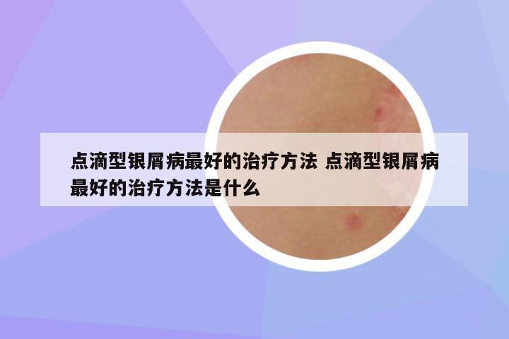 点滴型银屑病最好的治疗方法 点滴型银屑病最好的治疗方法是什么