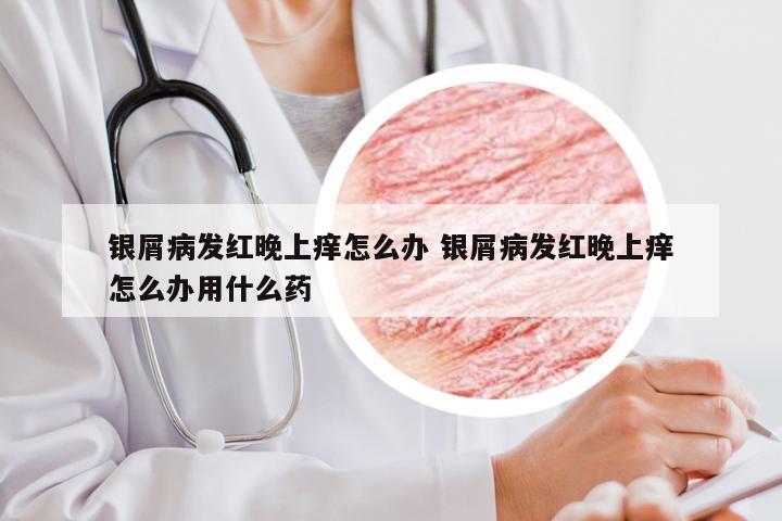 银屑病发红晚上痒怎么办 银屑病发红晚上痒怎么办用什么药