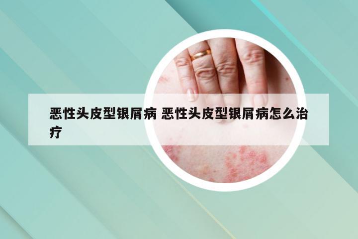 恶性头皮型银屑病 恶性头皮型银屑病怎么治疗