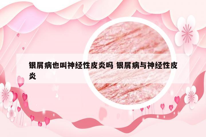银屑病也叫神经性皮炎吗 银屑病与神经性皮炎