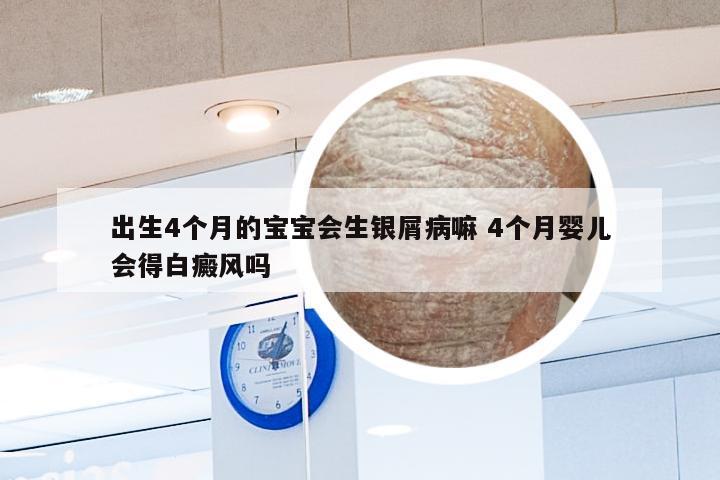 出生4个月的宝宝会生银屑病嘛 4个月婴儿会得白癜风吗