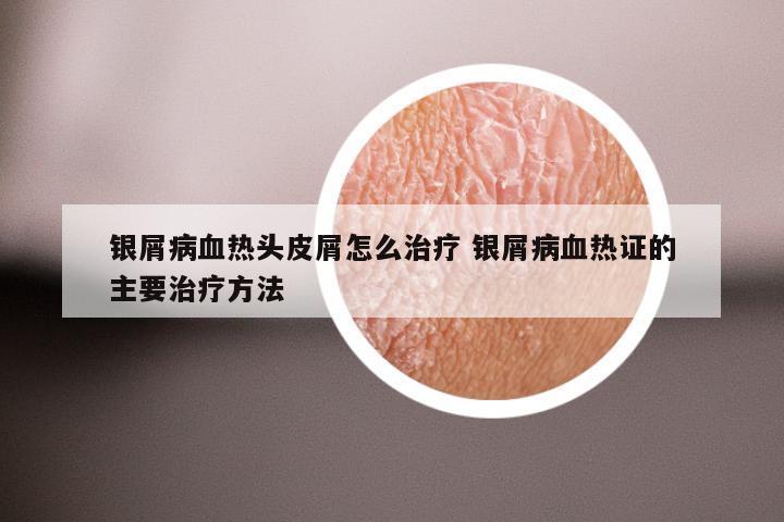 银屑病血热头皮屑怎么治疗 银屑病血热证的主要治疗方法
