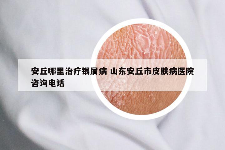 安丘哪里治疗银屑病 山东安丘市皮肤病医院咨询电话