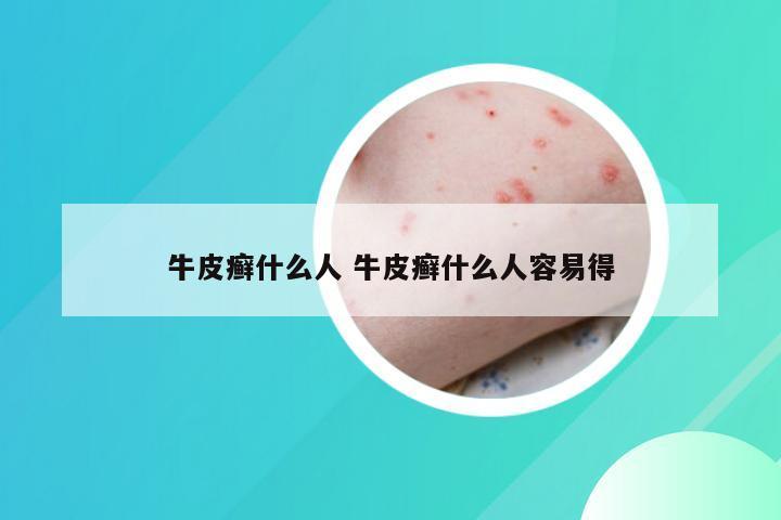 牛皮癣什么人 牛皮癣什么人容易得