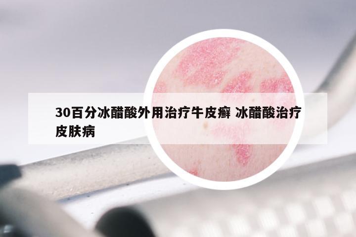 30百分冰醋酸外用治疗牛皮癣 冰醋酸治疗皮肤病