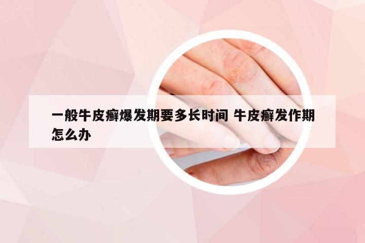 一般牛皮癣爆发期要多长时间 牛皮癣发作期怎么办