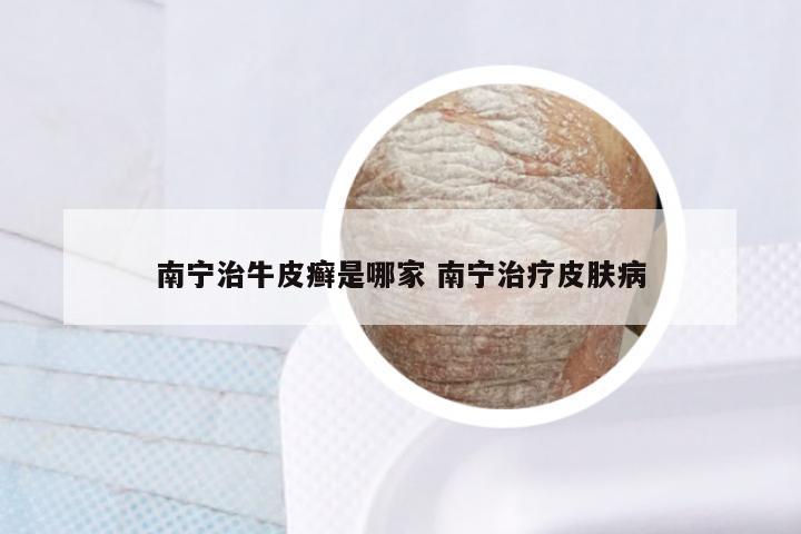 南宁治牛皮癣是哪家 南宁治疗皮肤病
