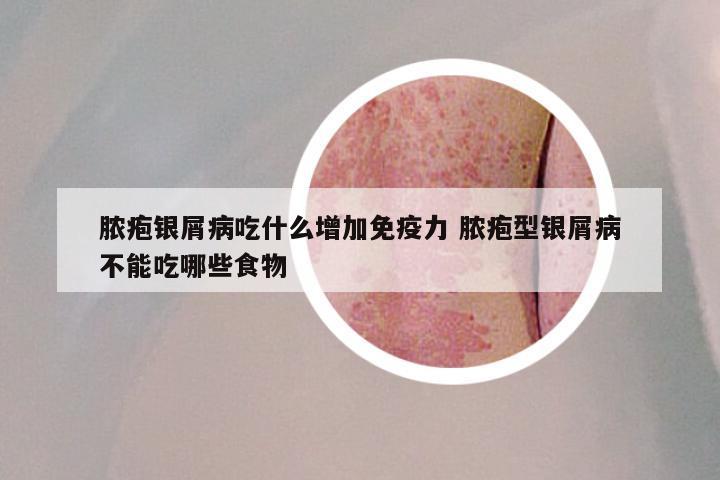 脓疱银屑病吃什么增加免疫力 脓疱型银屑病不能吃哪些食物