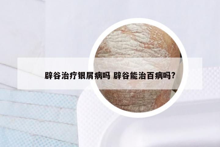 辟谷治疗银屑病吗 辟谷能治百病吗?