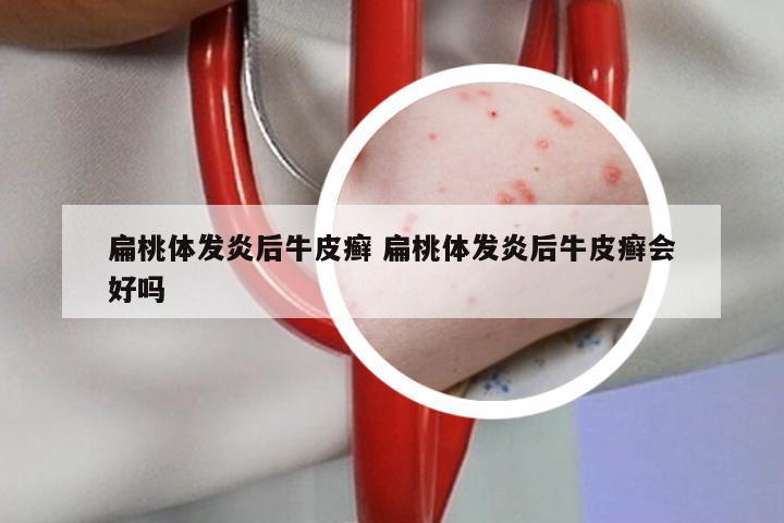 扁桃体发炎后牛皮癣 扁桃体发炎后牛皮癣会好吗