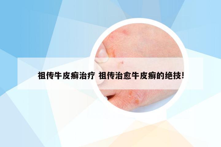 祖传牛皮癣治疗 祖传治愈牛皮癣的绝技!