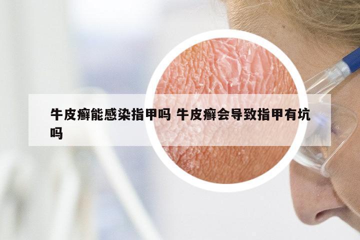 牛皮癣能感染指甲吗 牛皮癣会导致指甲有坑吗