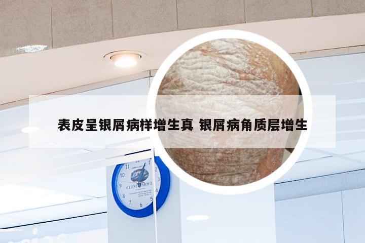 表皮呈银屑病样增生真 银屑病角质层增生