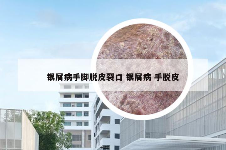 银屑病手脚脱皮裂口 银屑病 手脱皮