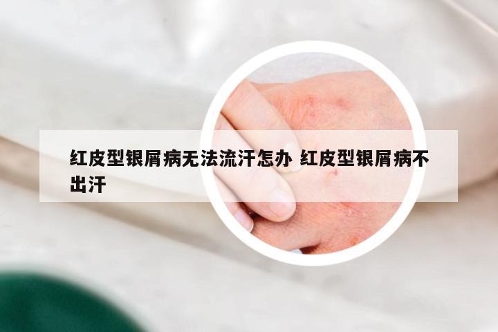红皮型银屑病无法流汗怎办 红皮型银屑病不出汗