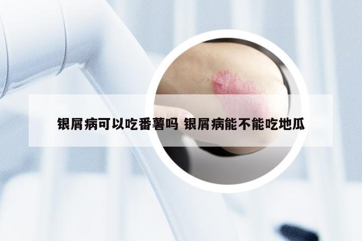 银屑病可以吃番薯吗 银屑病能不能吃地瓜
