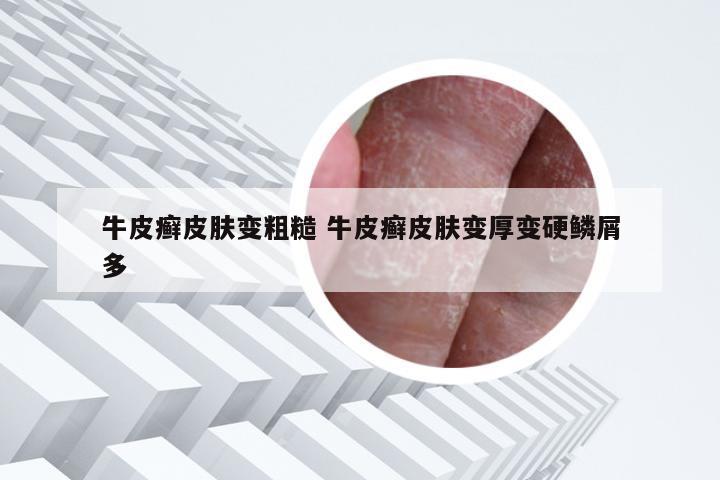 牛皮癣皮肤变粗糙 牛皮癣皮肤变厚变硬鳞屑多