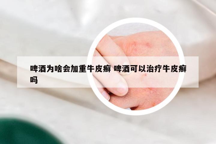 啤酒为啥会加重牛皮癣 啤酒可以治疗牛皮癣吗