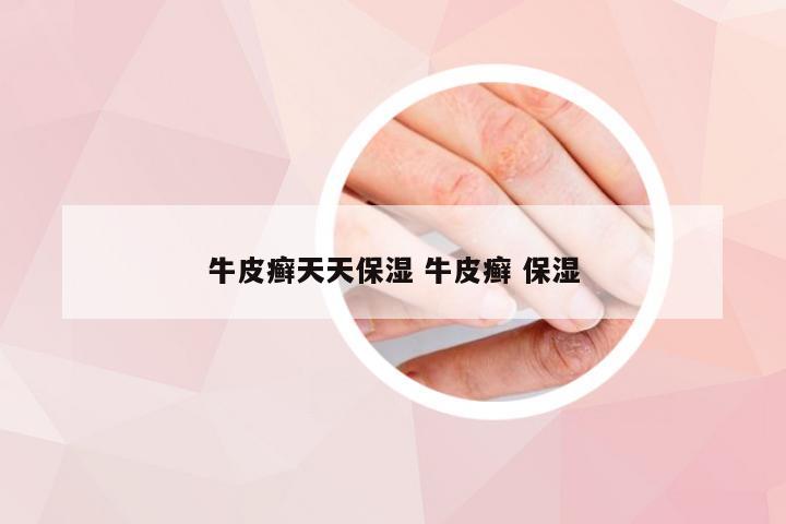 牛皮癣天天保湿 牛皮癣 保湿