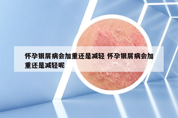 怀孕银屑病会加重还是减轻 怀孕银屑病会加重还是减轻呢