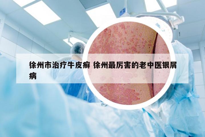 徐州市治疗牛皮癣 徐州最厉害的老中医银屑病