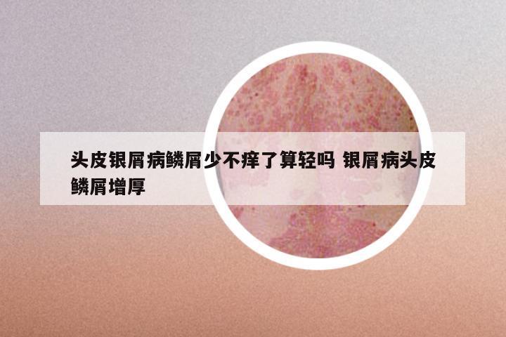 头皮银屑病鳞屑少不痒了算轻吗 银屑病头皮鳞屑增厚